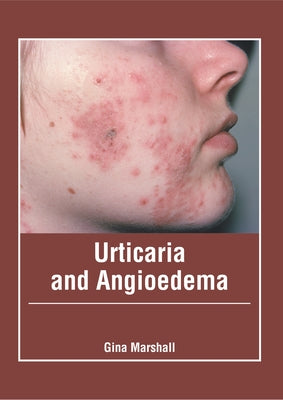 Urticaria and Angioedema by Marshall, Gina