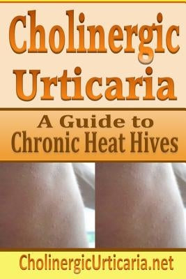 Cholinergic Urticaria: A Guide to Chronic Heat Hives by Page, B.